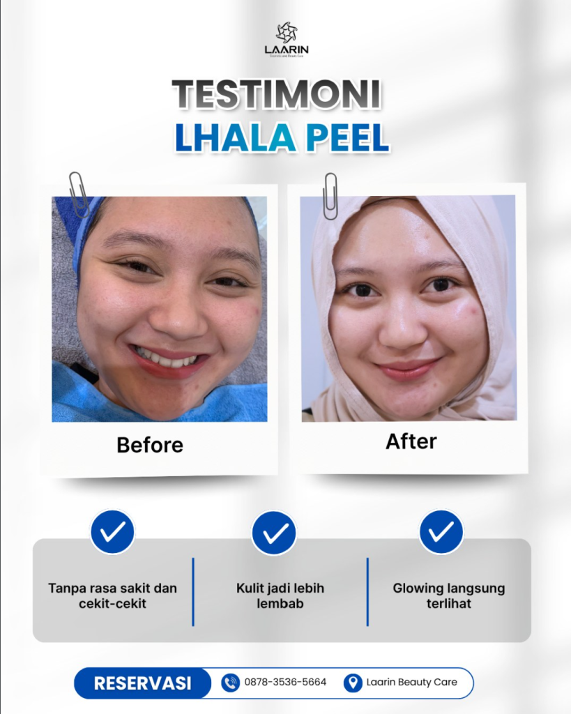 Testimoni Laarin Lhala Peel Treatment Solo-Boyolali
