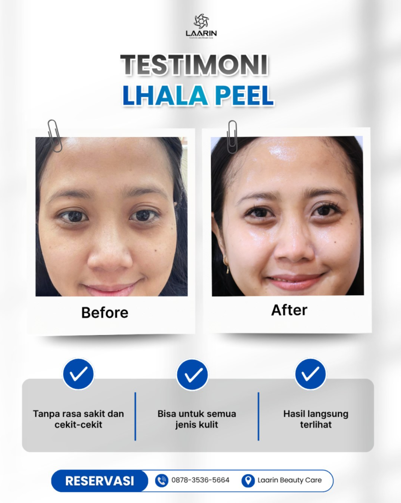 Testimoni Laarin Lhala Peel Treatment Solo-Boyolali