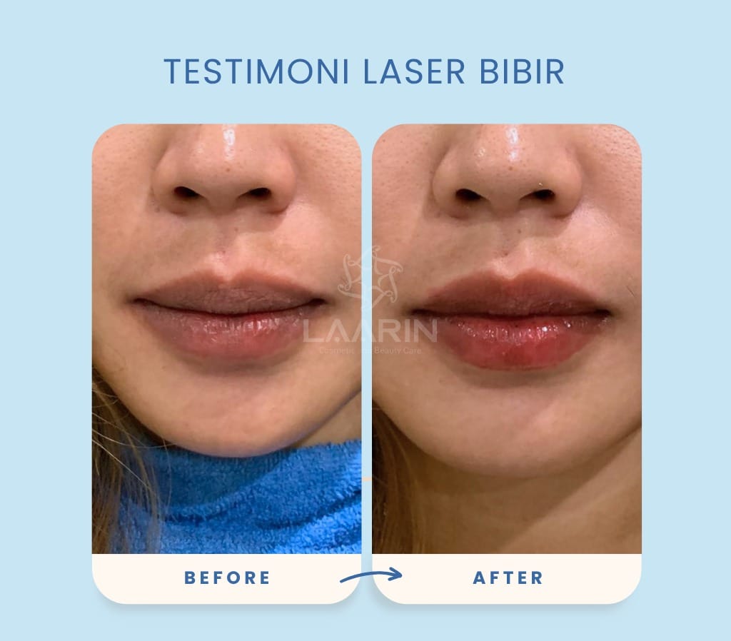 Laser Bibir di Boyolali dan Solo: Hasil Nyata dari 5 Klien Laarin Beauty Care